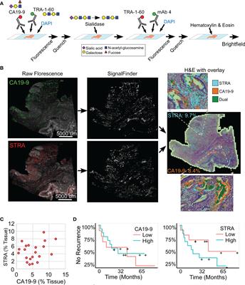 Heterogeneity of glycan biomarker clusters as an indicator of recurrence in pancreatic cancer